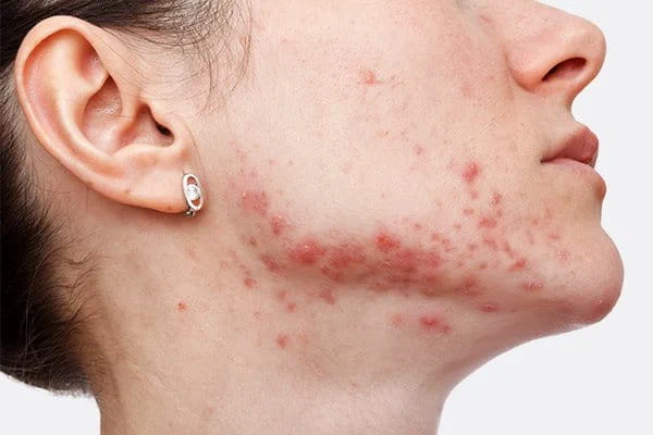 Post-Inflammatory Hyperpigmentation
